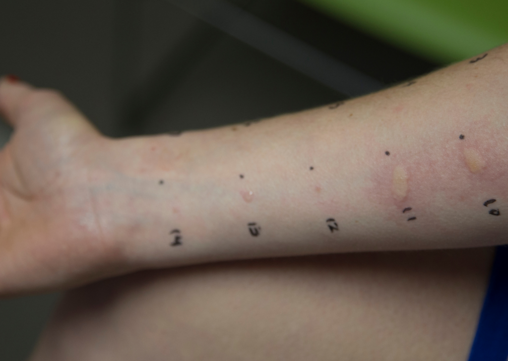 ALLERGY