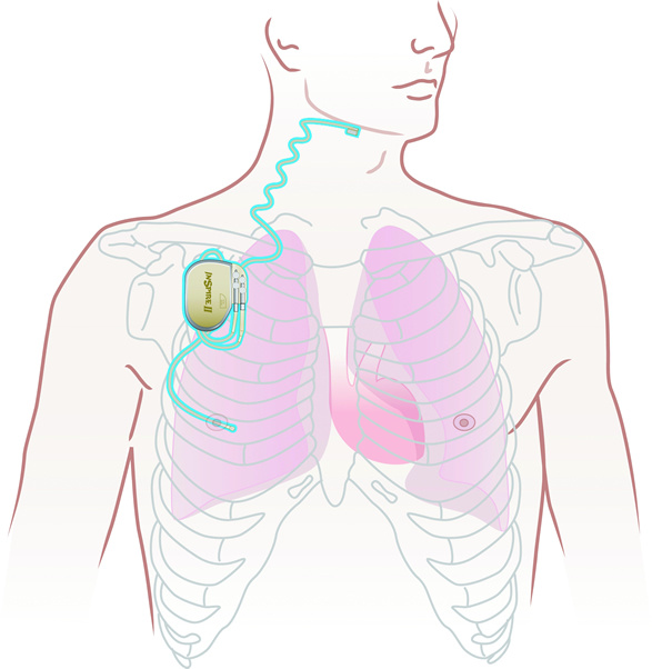 Sleep Apnea